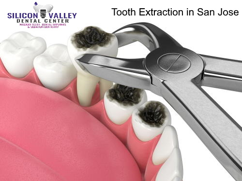 Emergency tooth extraction in San Jose