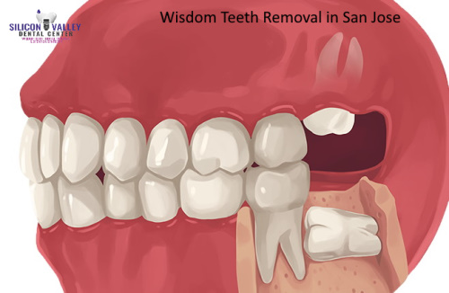 Wisdom Teeth Extraction in San Jose