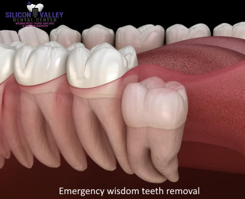 Emergency wisdom teeth removal in San Jose